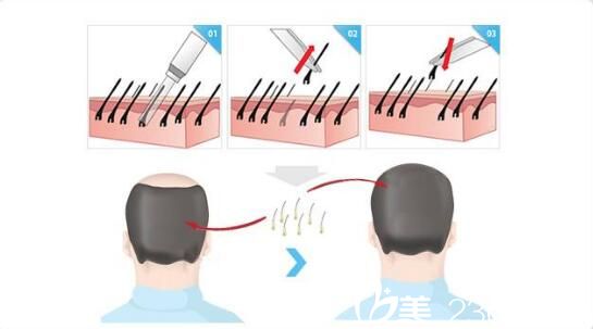 韓國(guó)RUBY如妃整形外科醫(yī)院毛發(fā)移植