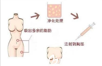 韓國RUBY如妃整形外科醫(yī)院自體脂肪移植胸 韓國RUBY如妃整形外科醫(yī)院自體脂肪移植胸