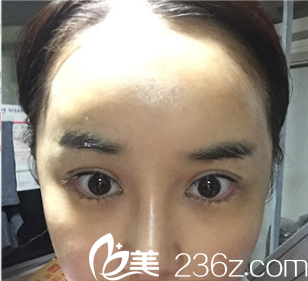 在韓國夢想整形醫(yī)院做切開+隆鼻一個月，樸良洙院長案例