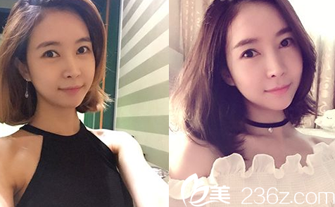 韓國(guó)JJ洪鎮(zhèn)柱整形醫(yī)院洪鎮(zhèn)柱做輪廓手術(shù)真人<span style= 韓國(guó)JJ洪鎮(zhèn)柱整形醫(yī)院洪鎮(zhèn)柱做輪廓手術(shù)真人<span style=