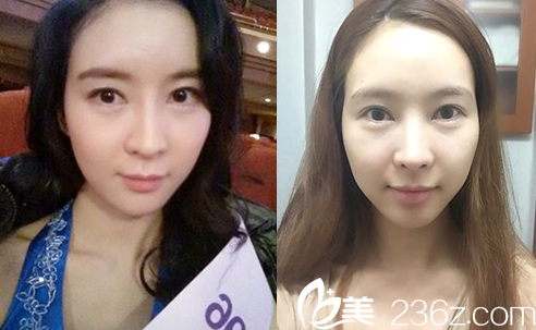 韓國(guó)JJ洪鎮(zhèn)柱整形醫(yī)院洪鎮(zhèn)柱做輪廓手術(shù)真人<span style= 韓國(guó)JJ洪鎮(zhèn)柱整形醫(yī)院洪鎮(zhèn)柱做輪廓手術(shù)真人<span style=