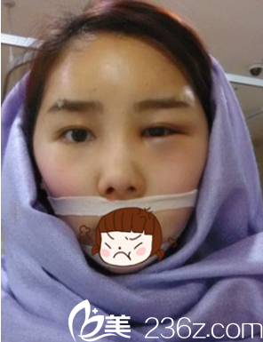 韓國(guó)JJ洪鎮(zhèn)柱整形醫(yī)院洪鎮(zhèn)柱做輪廓手術(shù)真人<span style= 韓國(guó)JJ洪鎮(zhèn)柱整形醫(yī)院洪鎮(zhèn)柱做輪廓手術(shù)真人<span style=