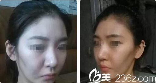 自體脂肪面部填充術(shù)前 自體脂肪面部填充術(shù)前