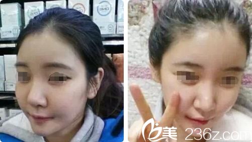 首次面部脂肪填充術(shù)后效果 首次面部脂肪填充術(shù)后效果