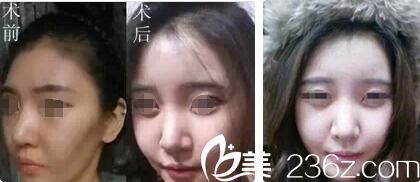 無錫同舟案例告訴你為什么脂肪要做二次填充效果才好