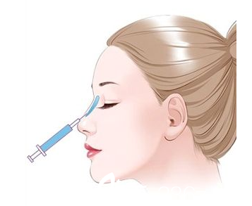 注射隆鼻示意圖