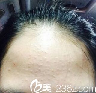 痘痘類型有哪些