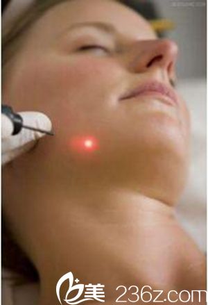 激光祛痘治療