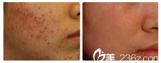 激光祛痘和痘印的效果