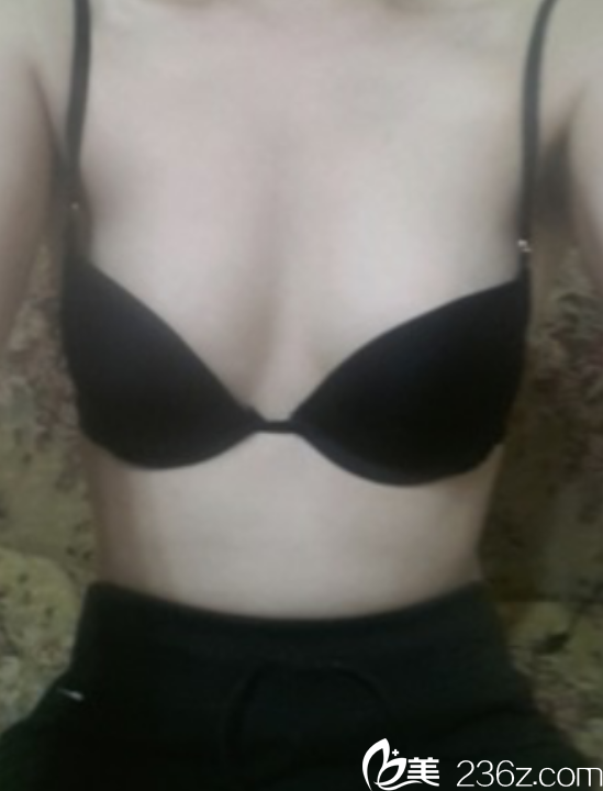 韓國赫爾希隆胸真人案例 