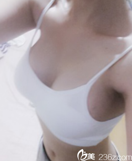 金應森院長做假體隆胸真人案例