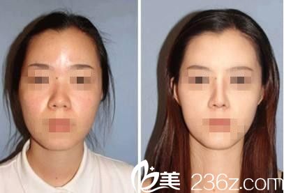   韓國RUBY如妃整形外科醫(yī)院李宇容做鼻子好不好？自體脂肪隆鼻真人案例