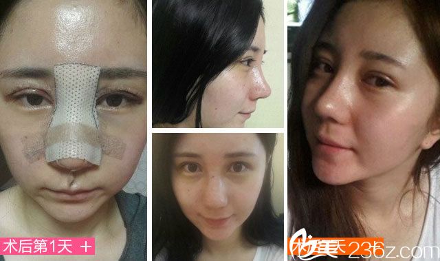 寧波尚麗喻氏微創(chuàng)無痕雙眼皮效果怎么樣？尚麗眼部整形真人案例