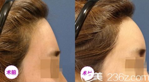 額部脂肪填充對比圖