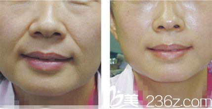 法令紋脂肪填充前后對比圖