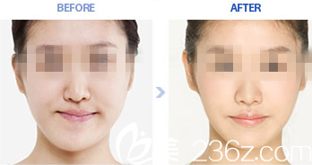 改善面部不對稱畸形前后對比圖