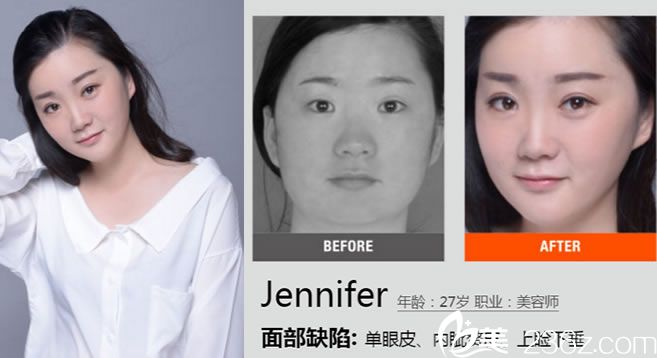 寧波薇琳王小東雙眼皮真人案例 寧波薇琳王小東雙眼皮真人案例