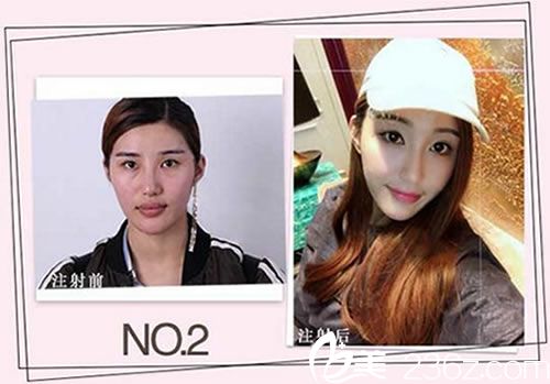 臺州藝星劉興達(dá)玻尿酸填充案例 臺州藝星劉興達(dá)玻尿酸填充案例