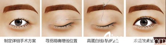 邱文苑醫(yī)生講述埋線法過程