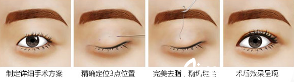 三點定位法是什么？<!--<i data=20240703-sp></i>-->伊萊美整形醫(yī)院邱文苑醫(yī)生告訴你。