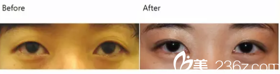 韓國(guó)iFace整形外科醫(yī)院案例 韓國(guó)iFace整形外科醫(yī)院案例