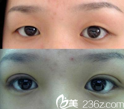 <!--<i data=20240703-sp></i>-->伊萊美整形醫(yī)院效果好不好？看邱文苑醫(yī)生的術(shù)后圖就知道。