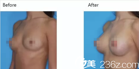 韓國iFace整形外科醫(yī)院案例