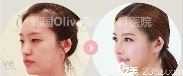 在韓國olive整形做隆鼻+脂肪豐鼻唇溝恢復(fù)照，潘準(zhǔn)燮院長案例