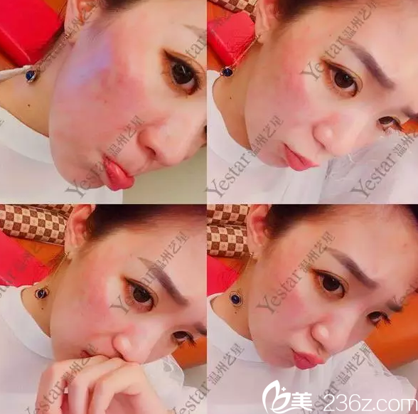 納秒鐳射祛斑術(shù)后即刻<span style=