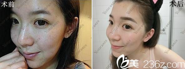 溫州藝星納秒鐳射祛斑前后<span style=