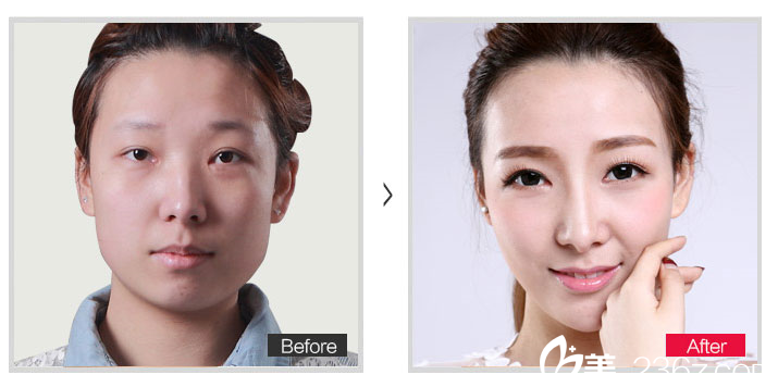 吳玉家醫(yī)生術后效果圖