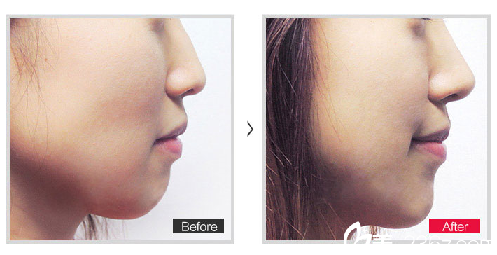 北京米蘭柏羽麗都整形醫(yī)院滿足你高挺鼻子的需求