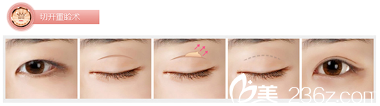 金奇龍院長告訴你切開法這樣做