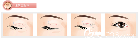 埋線法適合你嗎？金奇龍院長給你建議