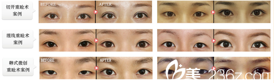 金奇龍院長術(shù)后對比圖