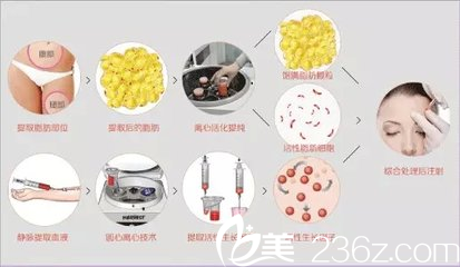 灰姑娘整形醫(yī)院自體脂肪提取過程