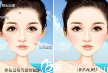 自體脂肪填充面部凹陷前后對比