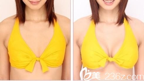 韓國高蘭得自體脂肪隆胸對比圖