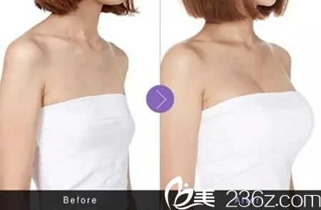 韓國高蘭得自體脂肪隆胸前后對比圖