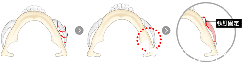 韓國Cooki 整形外科醫(yī)院鄭成模院長做顴骨手術(shù)怎么樣