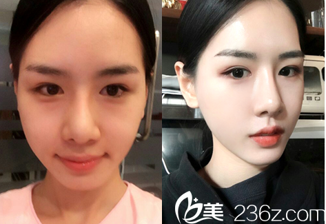 分享我在韓國cookie醫(yī)院做輪廓手術(shù)三個月的恢復(fù)日記 分享我在韓國cookie醫(yī)院做輪廓手術(shù)三個月的恢復(fù)日記