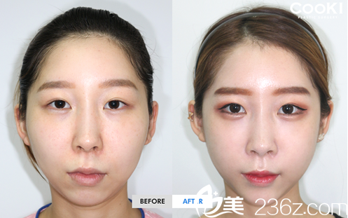 cookie醫(yī)院鄭成模做輪廓真的那么好嗎？多少錢？真人案例分享