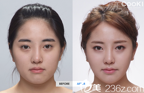 分享我在韓國cookie醫(yī)院做輪廓手術(shù)三個月的恢復(fù)日記 分享我在韓國cookie醫(yī)院做輪廓手術(shù)三個月的恢復(fù)日記