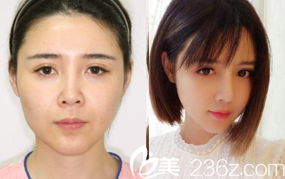 分享我在韓國cookie醫(yī)院做輪廓手術(shù)三個月的恢復(fù)日記 分享我在韓國cookie醫(yī)院做輪廓手術(shù)三個月的恢復(fù)日記