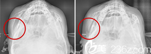 分享我在韓國cookie醫(yī)院做輪廓手術(shù)三個月的恢復(fù)日記 分享我在韓國cookie醫(yī)院做輪廓手術(shù)三個月的恢復(fù)日記