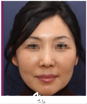 看我在Nano整形做隆鼻+脂肪豐臉恢復照，趙重衍院長案例