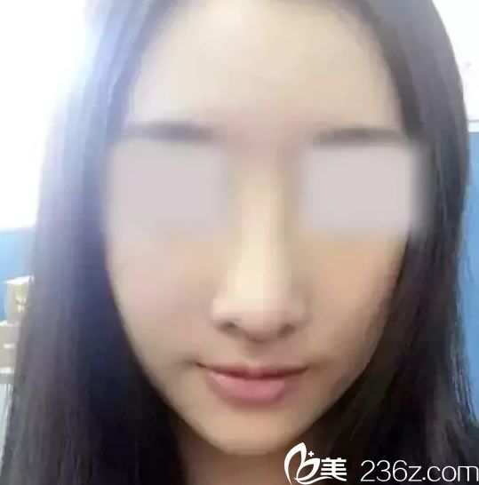 鼻綜合整形手術(shù)7天拆線<span style=