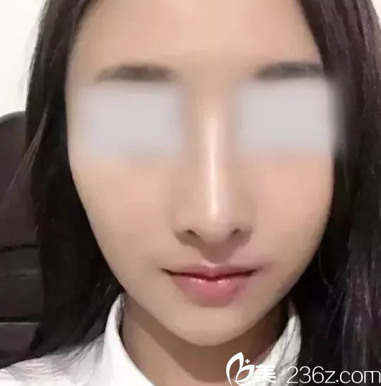 看我在寧波徐建國整形通過做鼻綜合手術改變塌鼻子的效果好嗎？