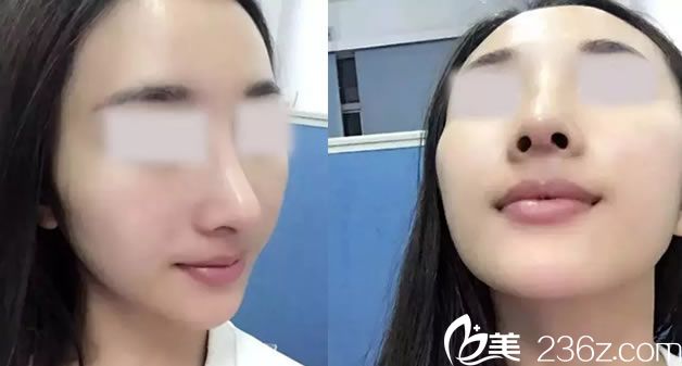 找徐建國做鼻子手術(shù)15天<span style=