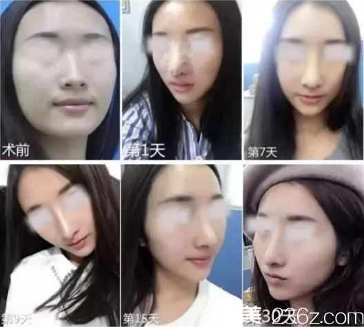 妹子在建國整形做鼻子恢復(fù)過程圖